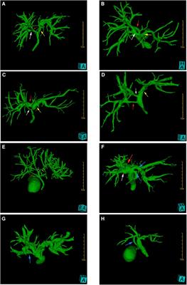 Application of three-dimensional visualization technology in the anatomical variations of hilar bile ducts in Chinese population